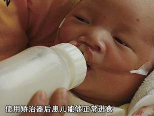 使用矯治器后患兒能夠正常進(jìn)食